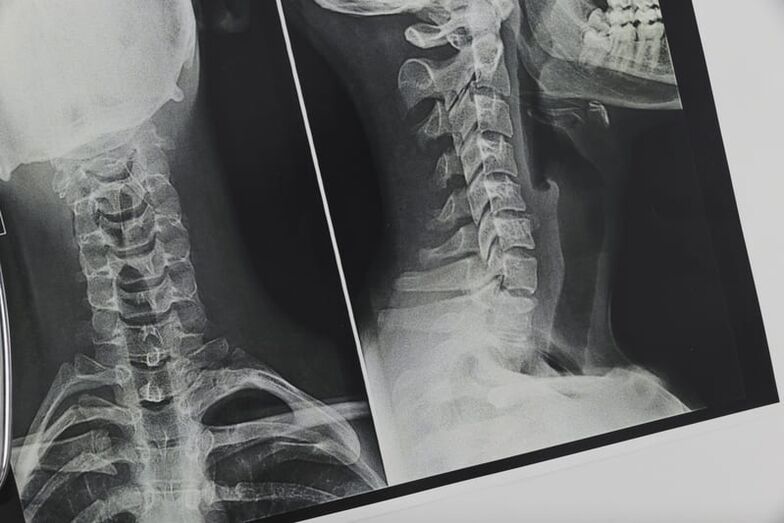 X-ray of the cervical spine affected by osteochondrosis