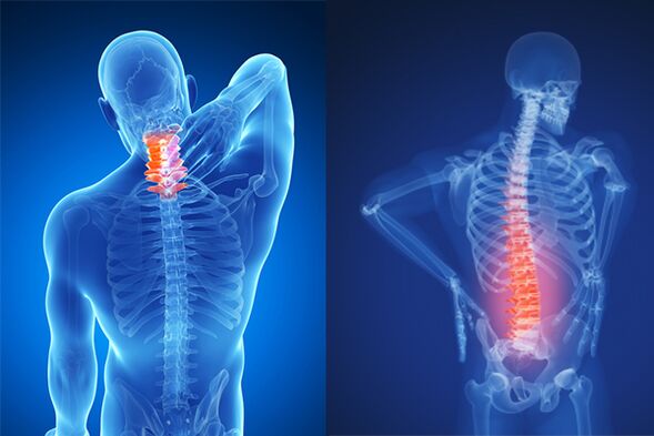 Osteochondrosis of the cervical and lumbar spine