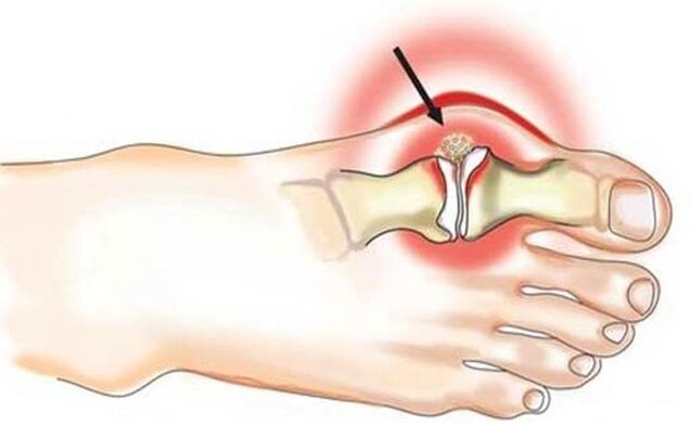 Inflammation of the joint between the big toe and foot due to arthritis