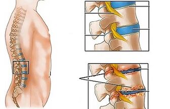 The causes of osteochondrosis of the lumbar