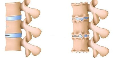 how to recognize the presence of osteochondrosis of the lumbar