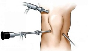 arthroscopy for arthrosis of the knee joint
