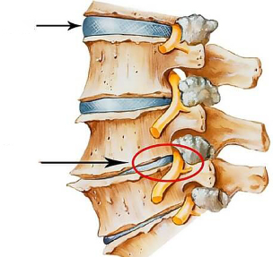 what does osteochondrosis look like